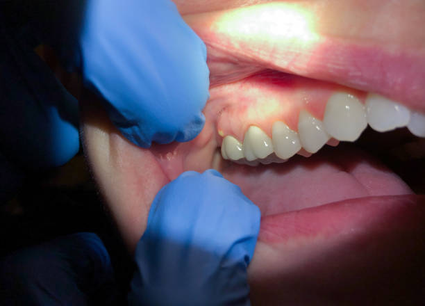 Best Tooth Infection Emergency Dentist  in South Hill, WA